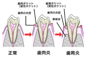 歯肉炎と歯周炎