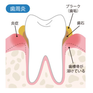 プラークの停滞と歯周病