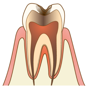むし歯C3